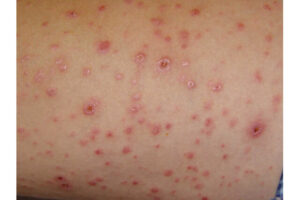 Read more about the article سلامت پوست در گرما: راهنمای پیشگیری از عفونت‌های شایع