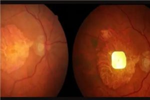 Read more about the article نابینایان با ایمپلنت هوش مصنوعی دوباره توانایی خواندن را به دست آوردند