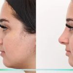 معیارهای بینی طبیعی مردانه و زنانه چرا قوس بینی همیشه مطلوب نیست؟