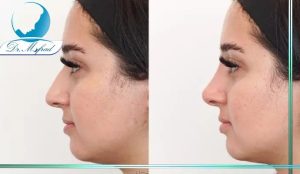 معیارهای بینی طبیعی مردانه و زنانه چرا قوس بینی همیشه مطلوب نیست؟